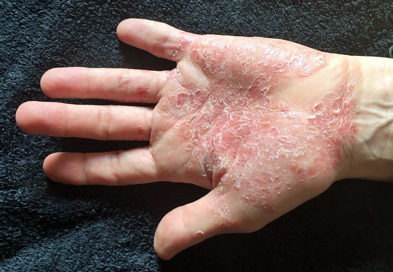 is psoriasis caused by stress