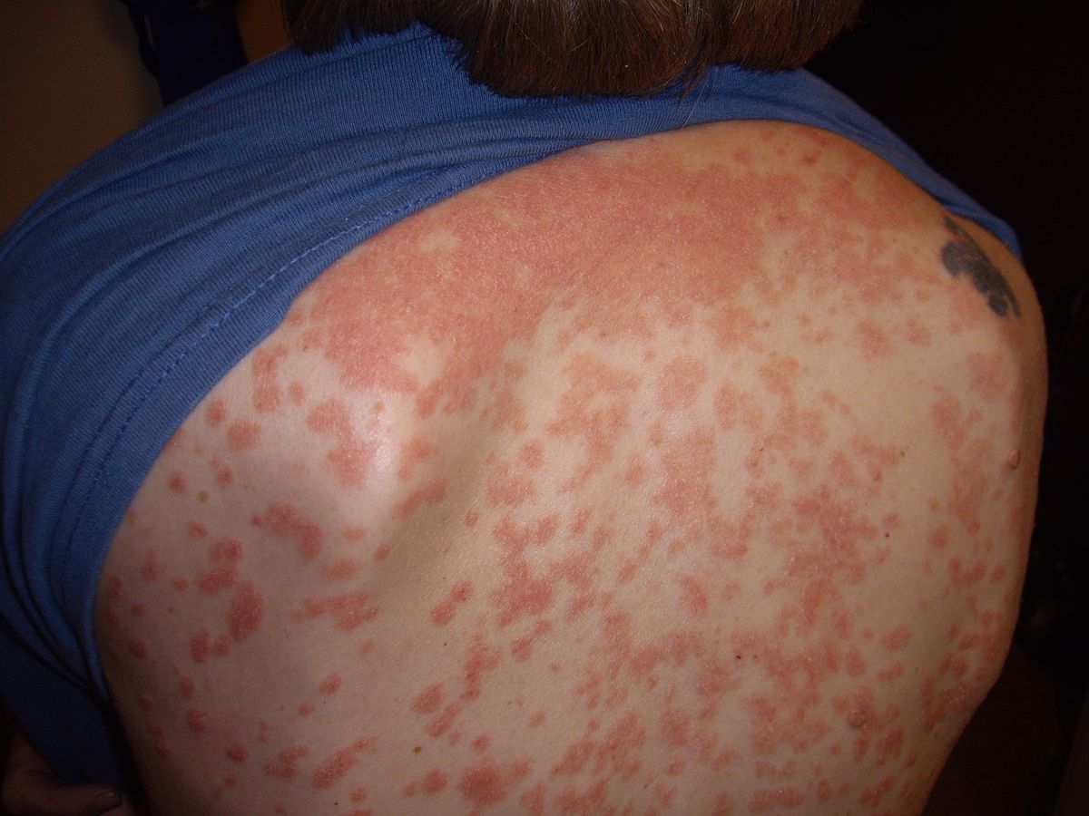 Skin után psoriasis