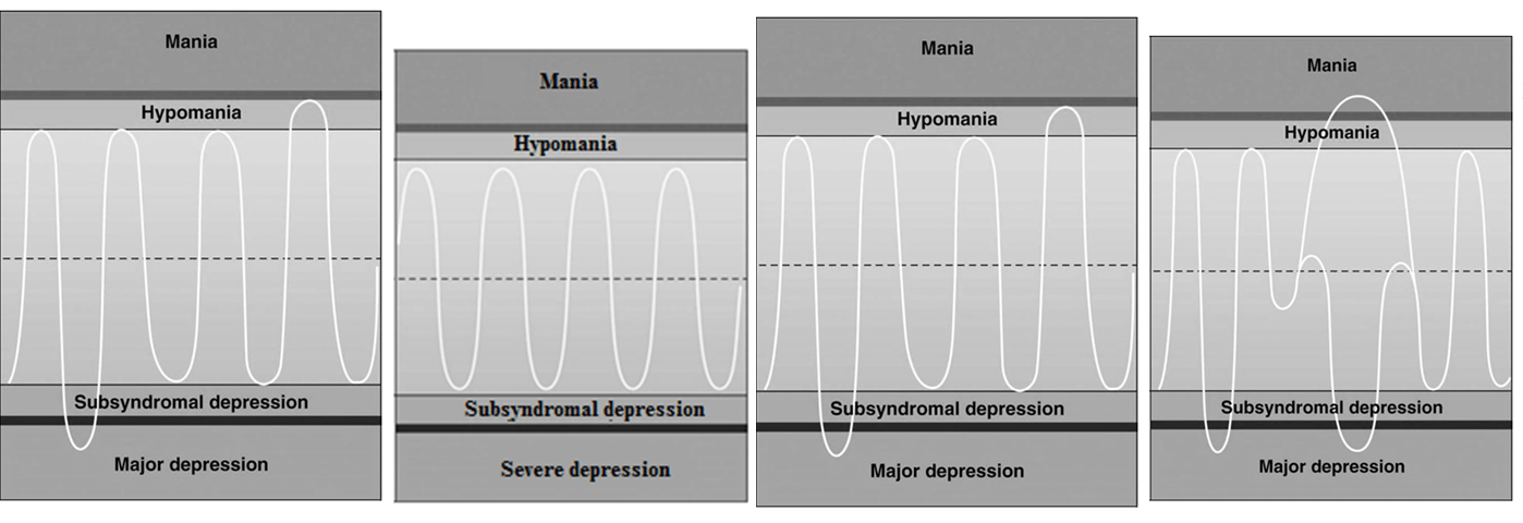 How To Diagnose Bipolar Disorder: DSM-5 Criteria | Betterhelp