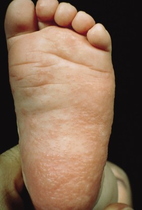 Stress Bumps On Fingers Eczema Hives Or Something Else Betterhelp